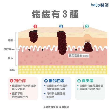 痣很凸|痣形成的原因？痣長毛、痣變多變大是痣病變？5招判別